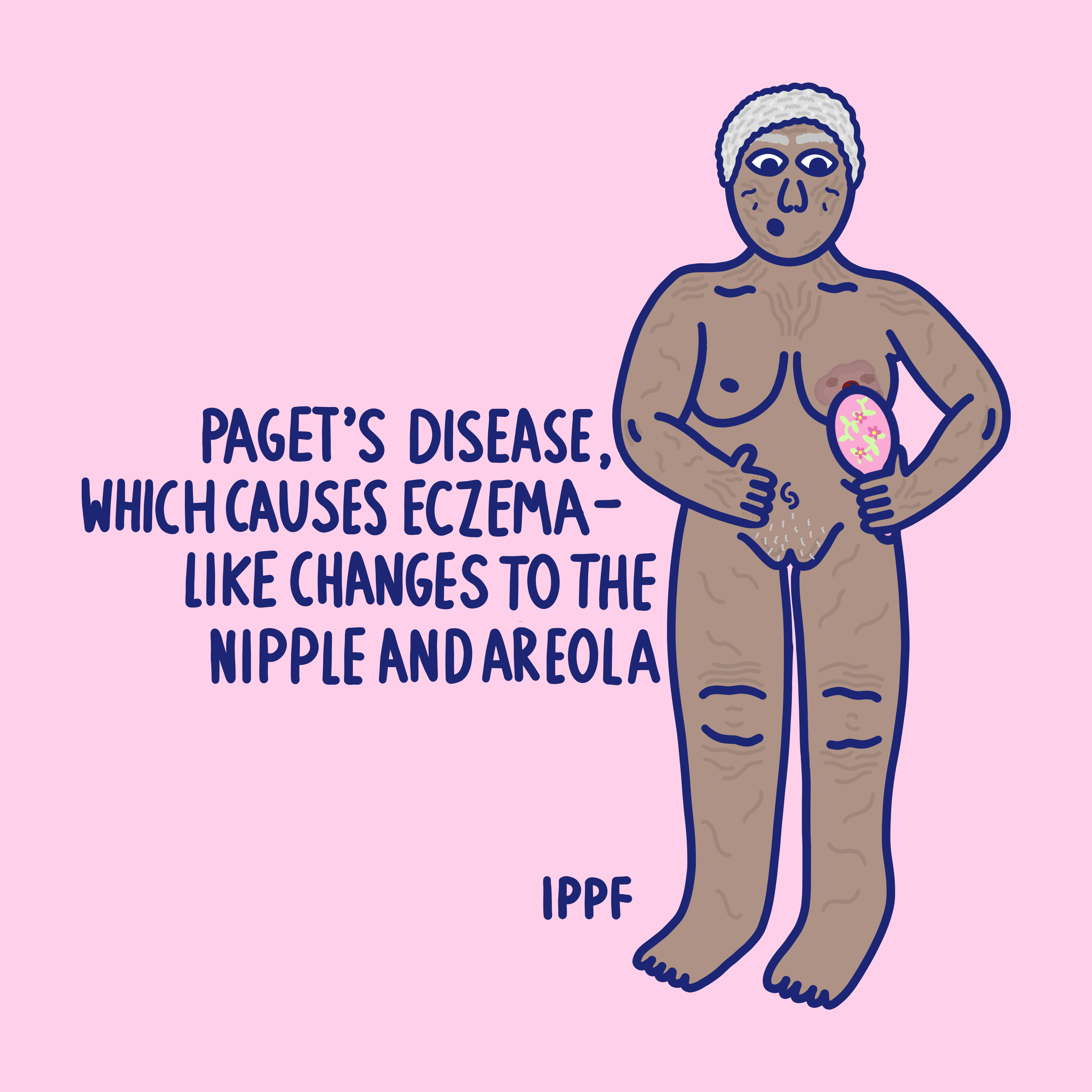 Pagets